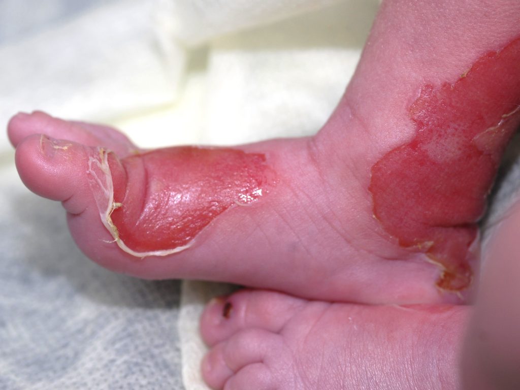 Dystrophic Epidermolysis Bullosa Treatment Market