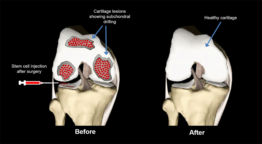 Regenerative Medicine for Cartilage Market