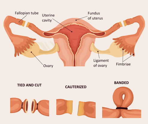 Female Sterilization Devices Market