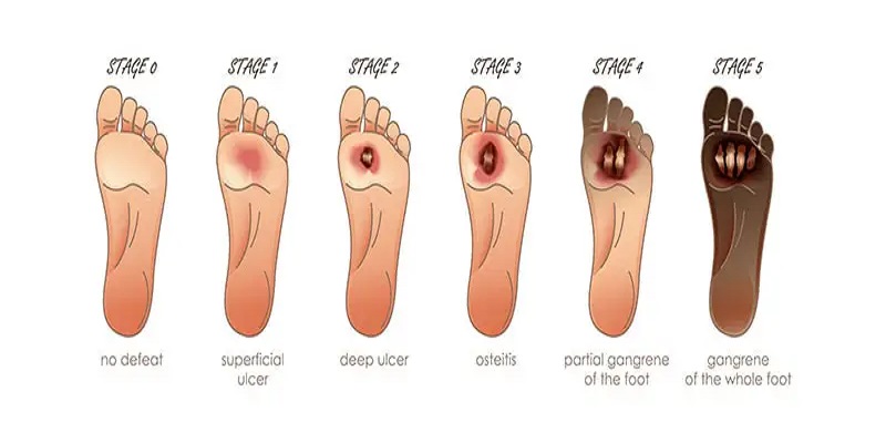 Diabetes Ulcer Treatment Market