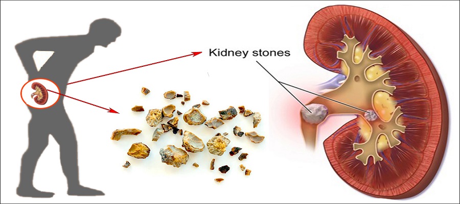 Kidney Stone Management Market