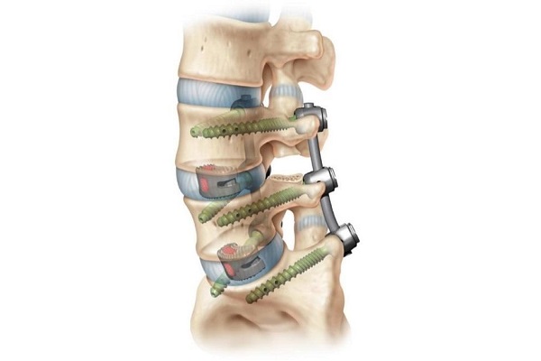 Spine Implant Market